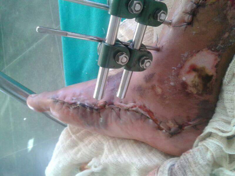 Fratura exposta nas duas pernas